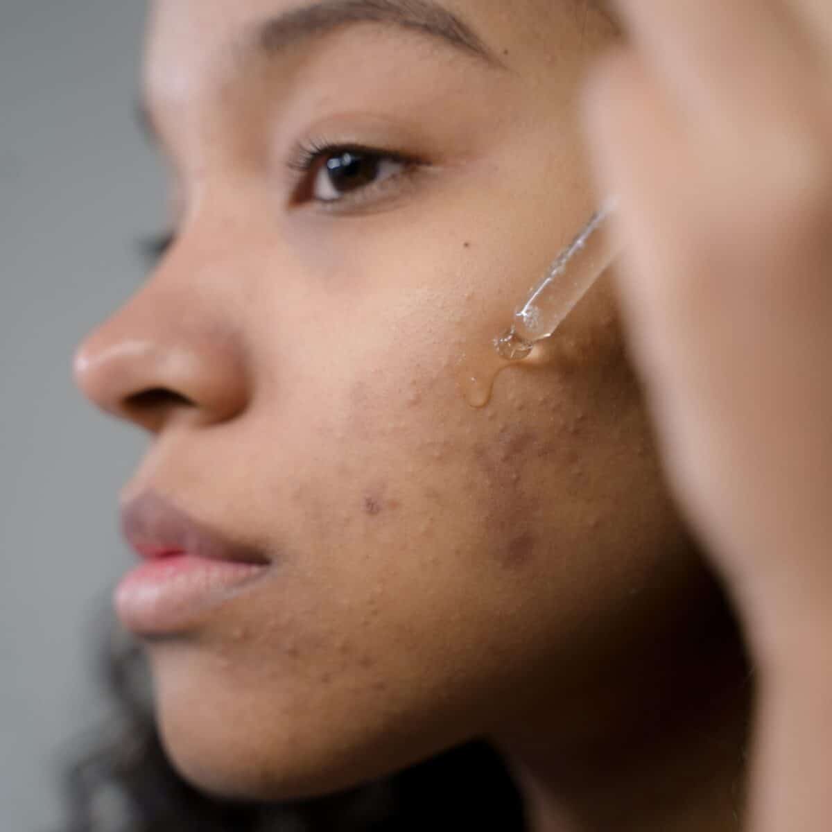 acne scar removal